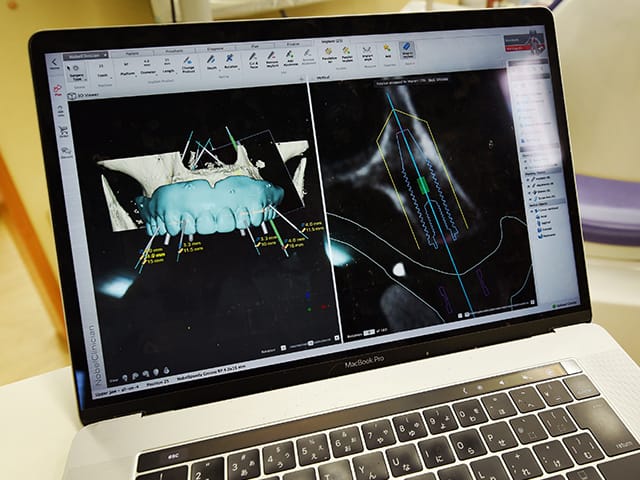 インプラントに関するパソコン画面